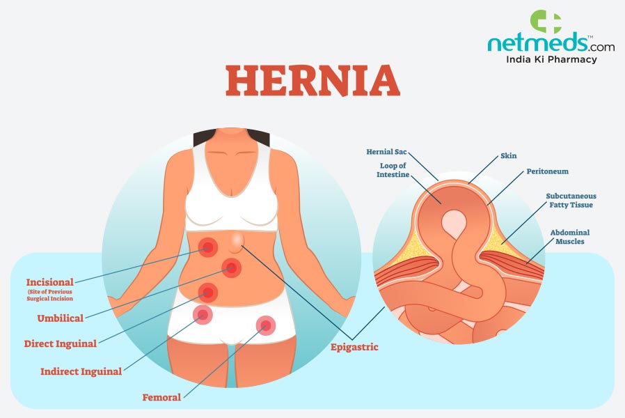 Types of Hernia.